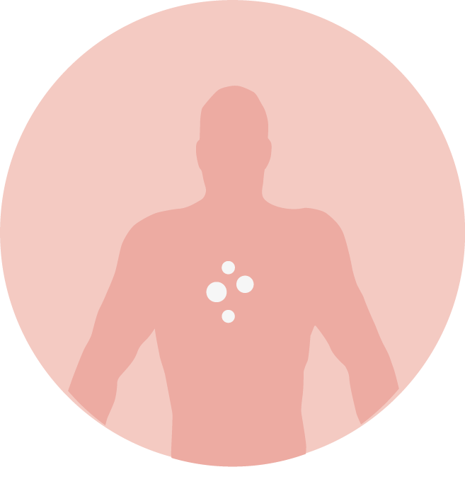 indication melanoma