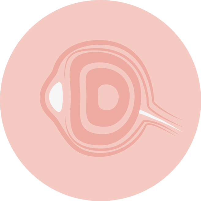 indication optoc nerve glioma